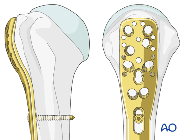 Start with a bicortical nonlocking screw through the elongated hole of the PHILOS in the meta/diaphyseal area.