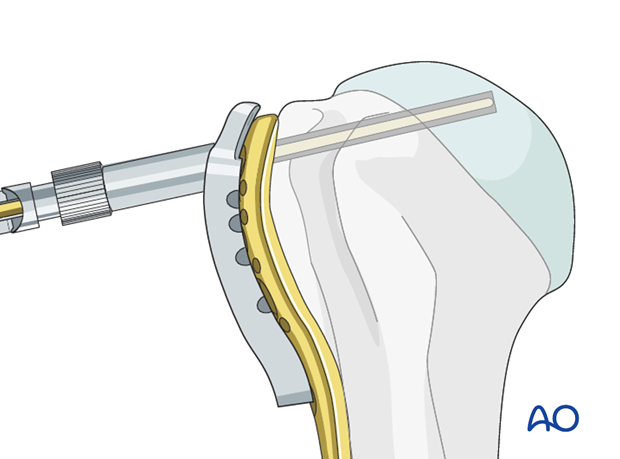 Determine screw length.