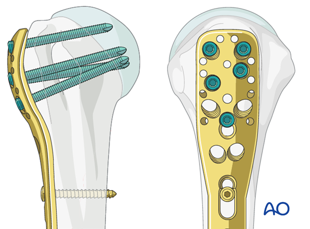 Place a sufficient number of screws into the humeral head.