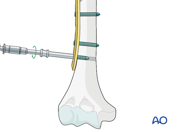 Plate fixation to humeral shaft