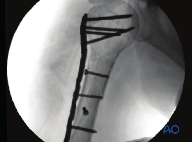 X-ray of osteosynthesis with PHILOS and lag screws