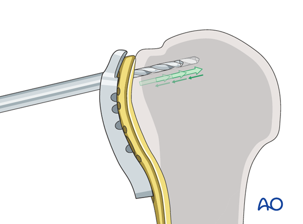 Use the guide block with drill sleeves to drill holes for the proximal screws.