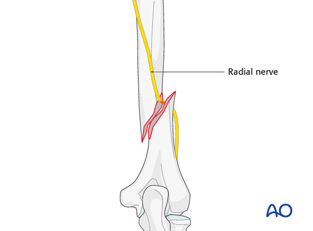 neurovascular injuries