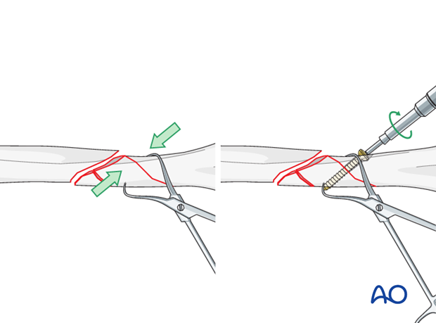 Lag screw fixation