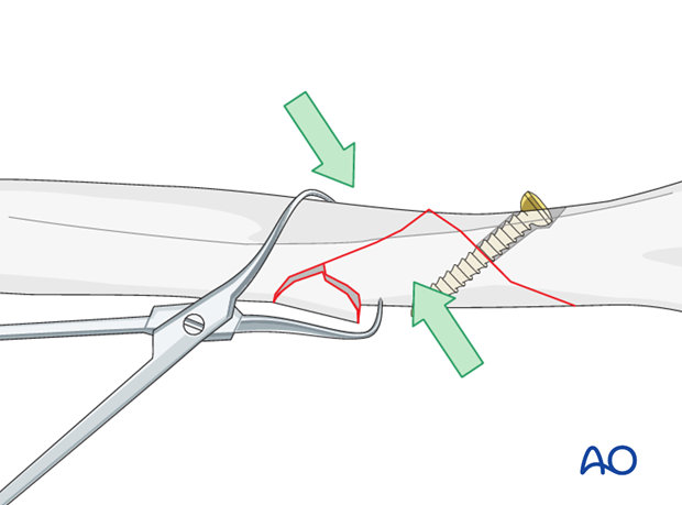 Lag screw fixation