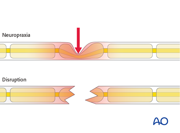 Neurovascular injuries