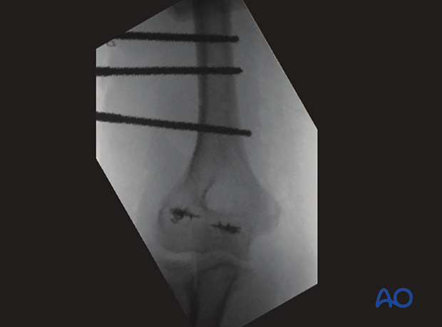 Case with radial nerve injury caused by fixator pins