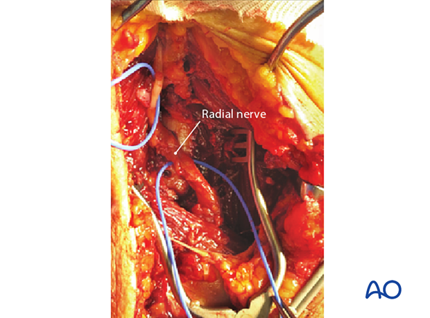 Intraoperative photo showing the radial nerve in continuity but tethered in scar close to where the pins had been placed