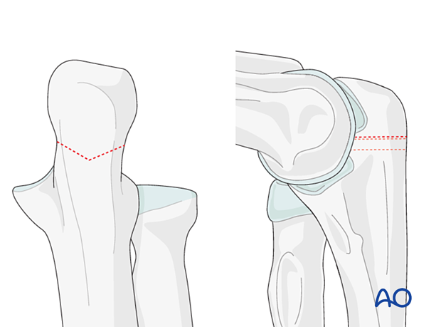 Lines of a planned chevron olecranon osteotomy