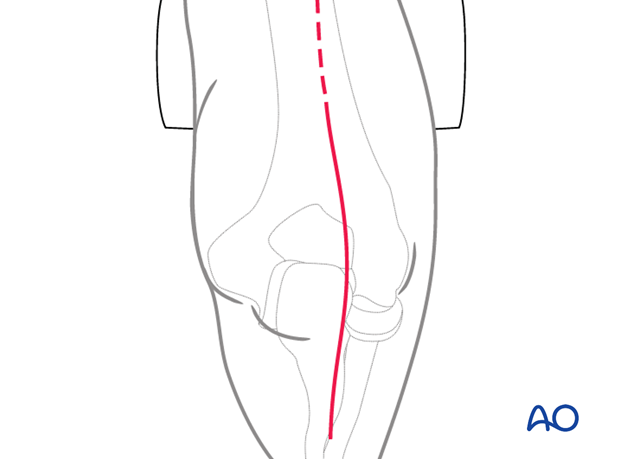 Skin incision for posterior triceps-split approach (Campbell)