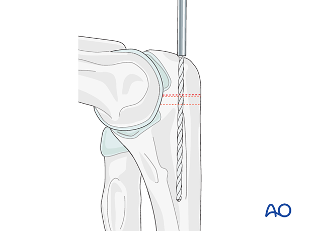 Predrilling for later osteotomy fixation with intramedullary screw