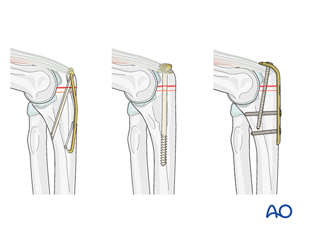 Options olecranon osteotomy fixation