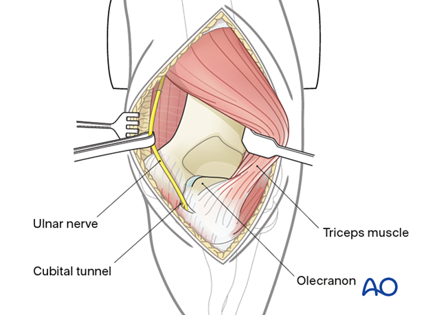 The distal humerus and distal humeral shaft can be exposed with the posterior paratricipital approach.