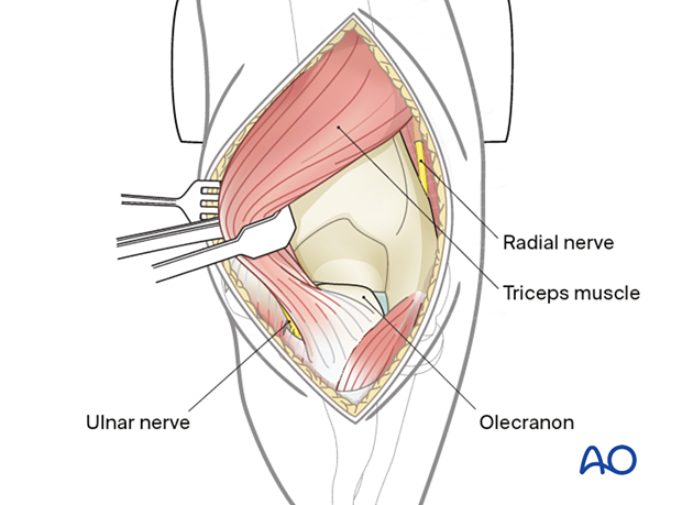 Radial window of the posterior paratricipital approach