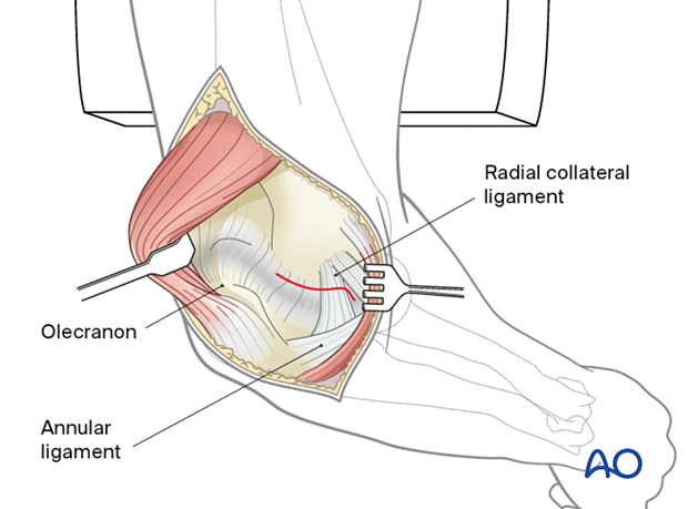 Incision of the posterolateral capsule on the lateral side of the ulnohumeral joint