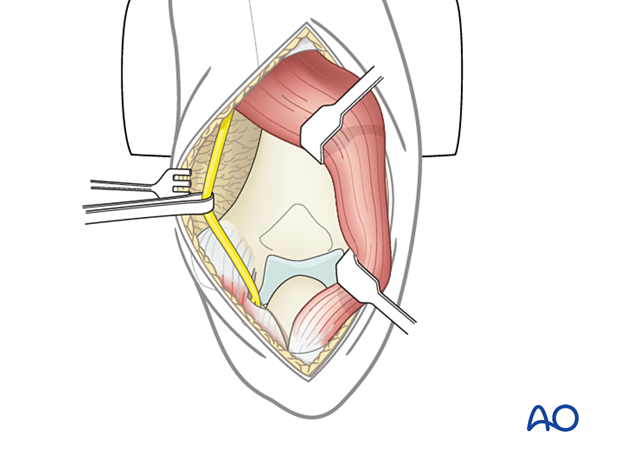 The triceps-elevating approach offers an extensile posterior exposure to the elbow joint by reflecting the triceps insertion from the olecranon.