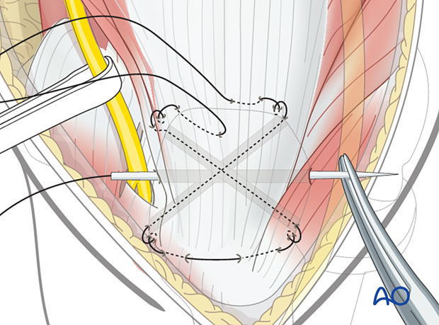 Reattachment of the triceps tendon insertion to the olecranon with transosseous sutures: passing sutures through the tunnels