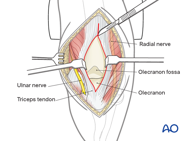 Further split the triceps tendon and aponeurosis proximally.