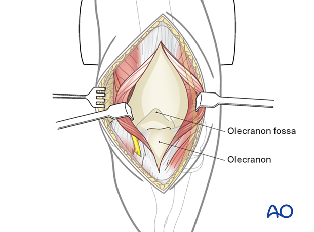 Soft-tissue retraction will now provide a wide view of the posterior aspect of the distal humerus.