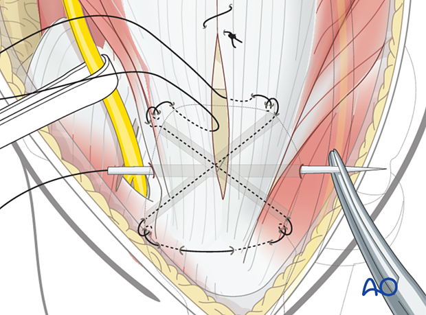 Oppose the tendon firmly to the olecranon using nonabsorbable sutures passed through these tunnels and the tendon with a straight needle.