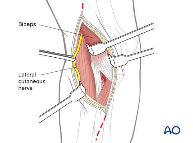 Incise the fascia over the biceps muscle belly and retract the biceps medially.