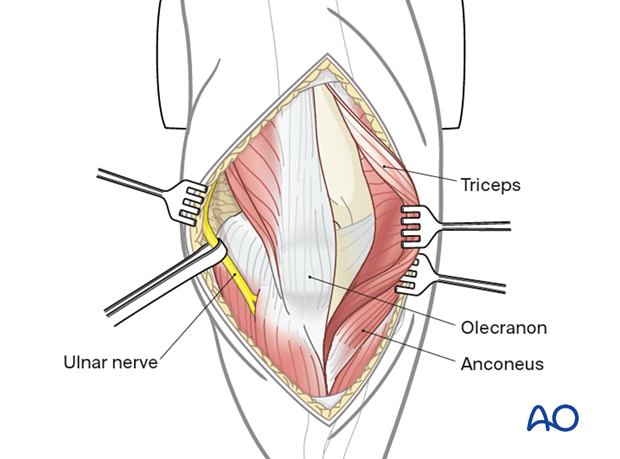 Lateral paraolecranon approach