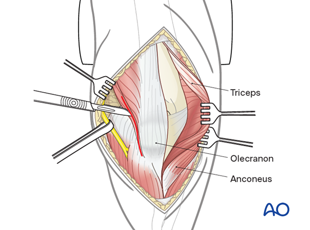 Lateral paraolecranon approach