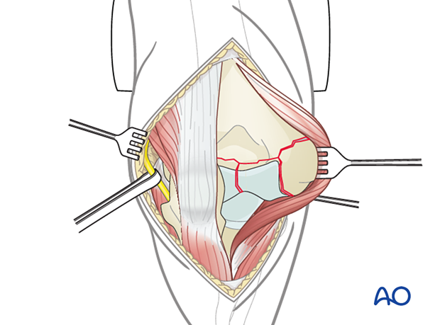 Lateral paraolecranon approach