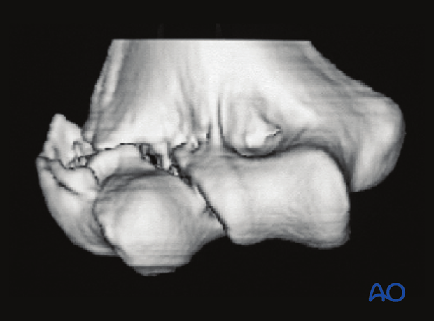 3-D CT reconstruction of partial articular, lateral sagittal, fragmentary transtrochlear fracture