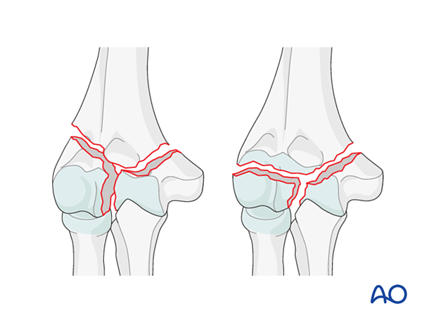 Complete simple articular and simple metaphyseal fracture