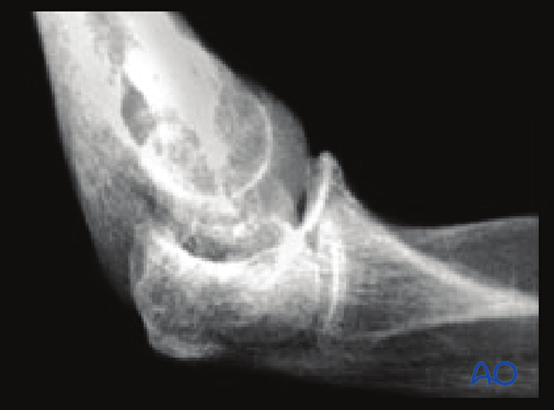 X-ray of complete simple articular and simple metaphyseal fracture