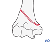 distal humerus