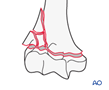 distal humerus