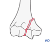 distal humerus