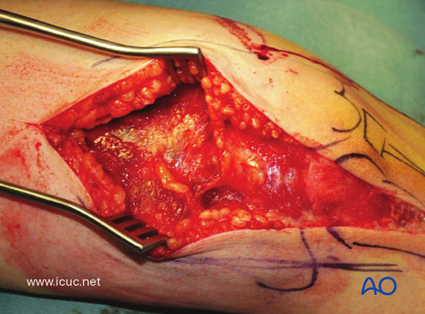 This is a complex, intraarticular fracture.