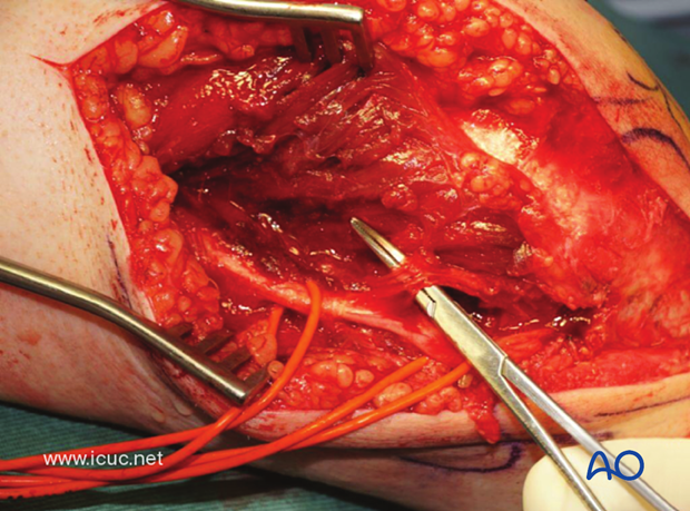 This image shows a carefully dissected and protected branch to the flexor carpi ulnaris.