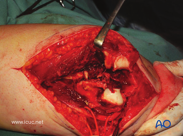 The olecranon osteotomy, when completed, reveals a badly comminuted C3 distal humeral fracture.