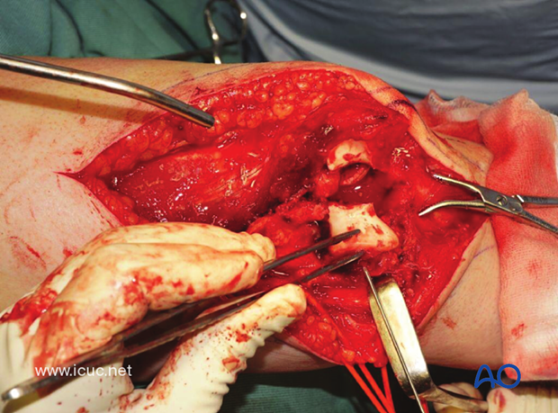 The surgical tactic is started by reducing the articular components, converting the C-type fracture into an A-type fracture.