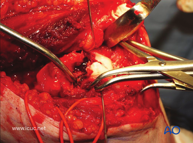 This intraoperative video demonstrates the joint reduction and the significant metaphyseal comminution.