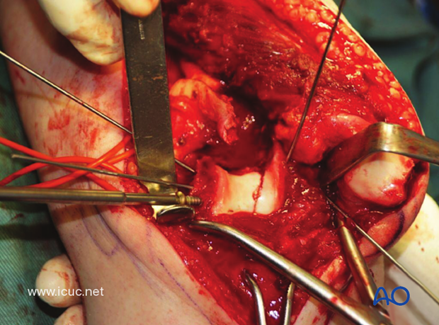 The carefully reconstructed joint surface is held nicely with a transcondylar lag screw.