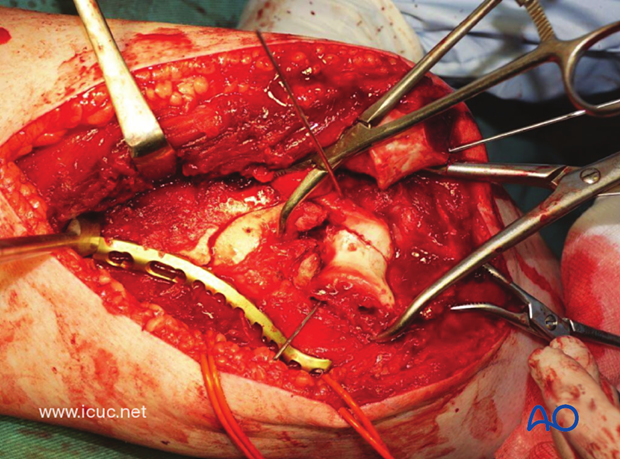 With the medial plate applied, the metaphyseal comminution is bridged temporarily.