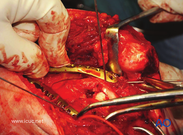 A posterolateral LCP can then be applied as a reduction plate to supplement the medial fixation.