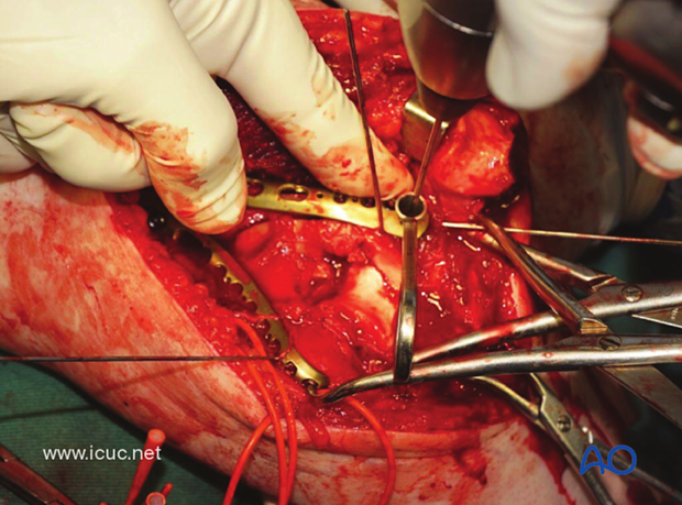 The variable angle lateral plate should obtain at least 3 points of distal fixation.