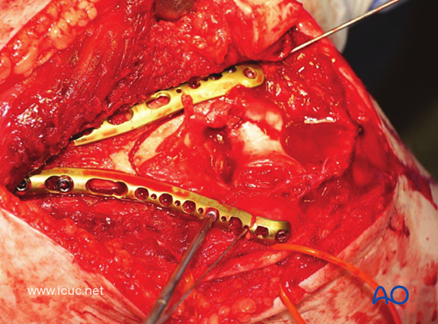 Once the two plates are fixed proximally and distally, further screws may be inserted, but the principle of bridging the comminuted fracture is maintained.