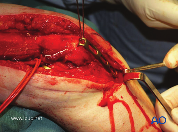 A hook plate is applied over the longitudinal K-wires to complete the fixation of the osteotomy.