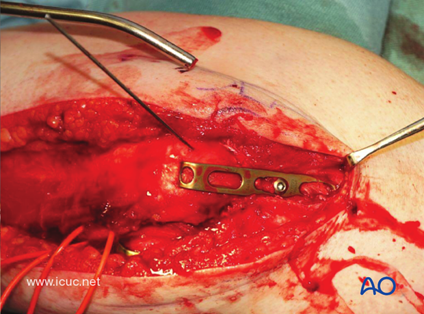 The osteotomy is nicely reduced with the hook plate.