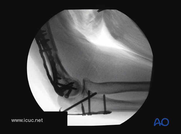 Lateral X-ray demonstrating the hook plate reduction of the Chevron osteotomy.