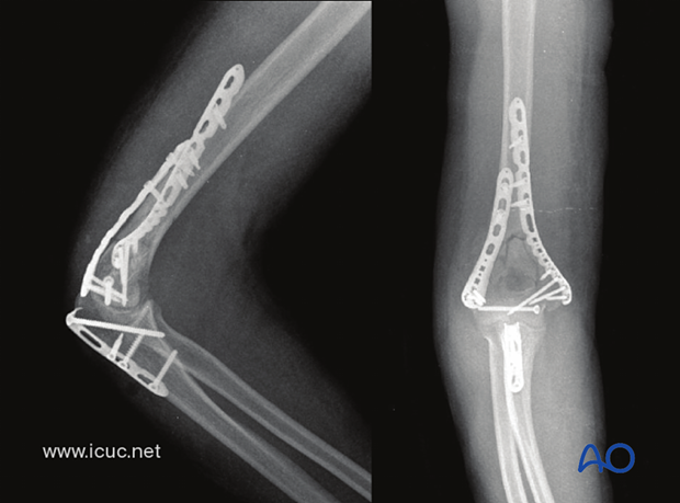 Final X-ray images