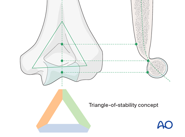 The mechanical properties of the distal humerus are based on a triangle of stability, comprising the medial and lateral columns and the articular block.