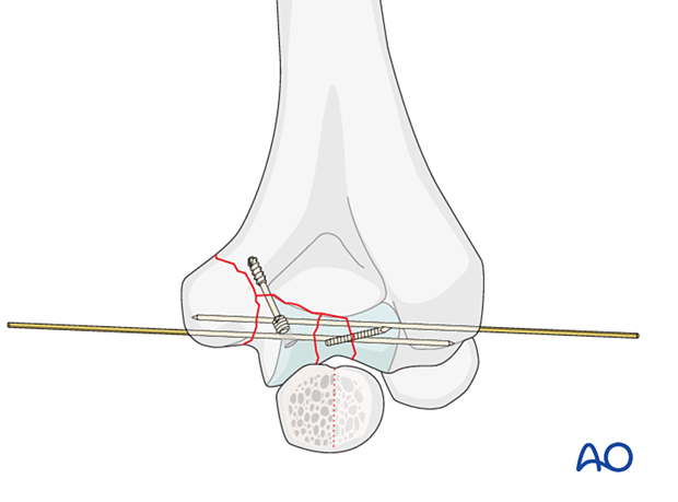 ORIF - Headless screw and plate fixation for Partial articular, medial ...